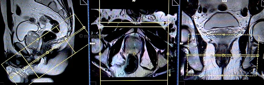 mri proctogram axial planning - MRI