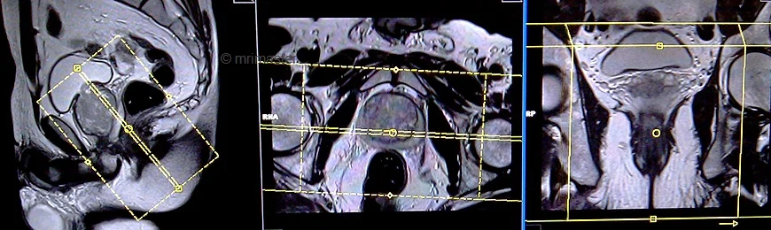 mri proctogram coronal planning - MRI