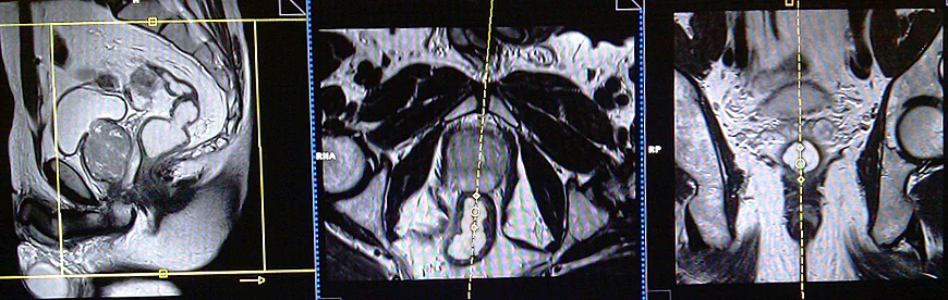 mri proctogram sagittal dynamic scans planning - MRI