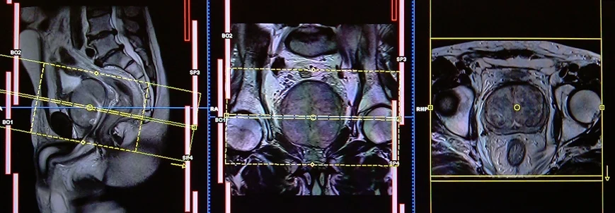 mri prostate axial planning 2 - MRI