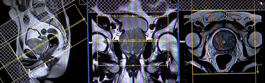 mri prostate axial planning 3 - MRI