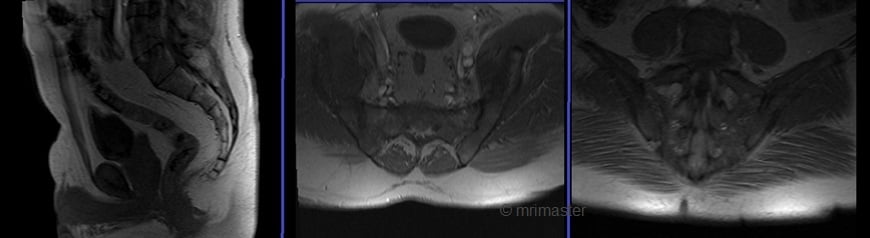 Мрт крестцово подвздошных сочленений режимы. Крестцово подвздошном сочленения МРРТ. Кт крестцово-подвздошных сочленений. Мрт крестцово-подвздошных сочленений.