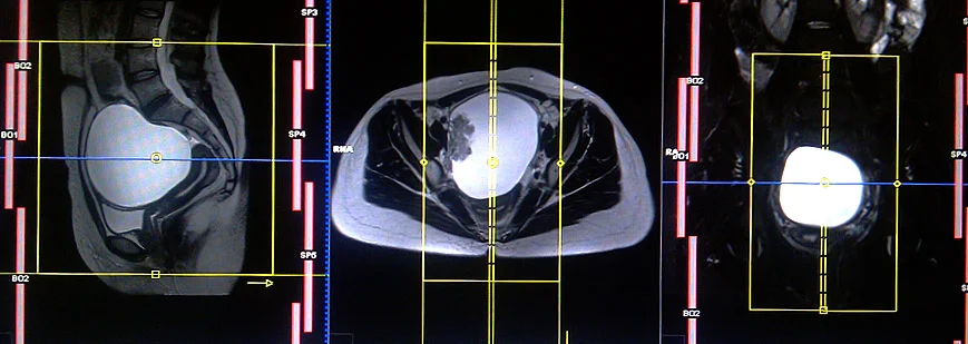 mri sagittal planning for ovarian cancers 3 - MRI