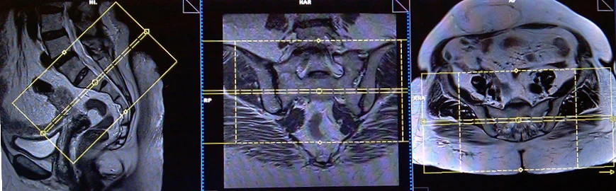 mri sijs axial planning 1 - MRI