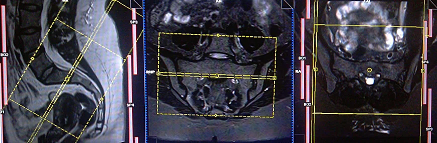 mri sijs axial planning - MRI