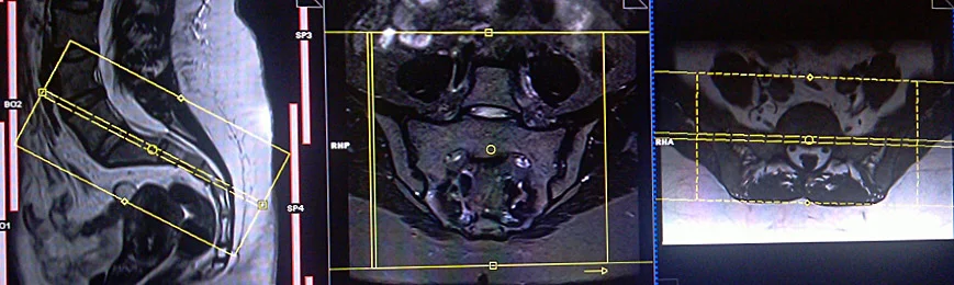 mri sijs coronal planning - MRI