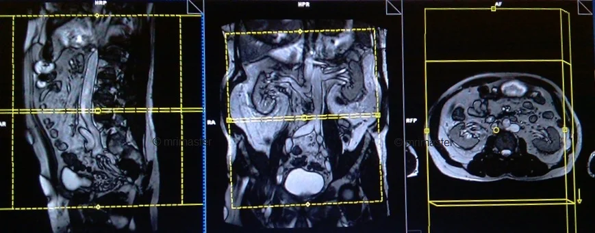 mrv abdomen axial image planning - MRI