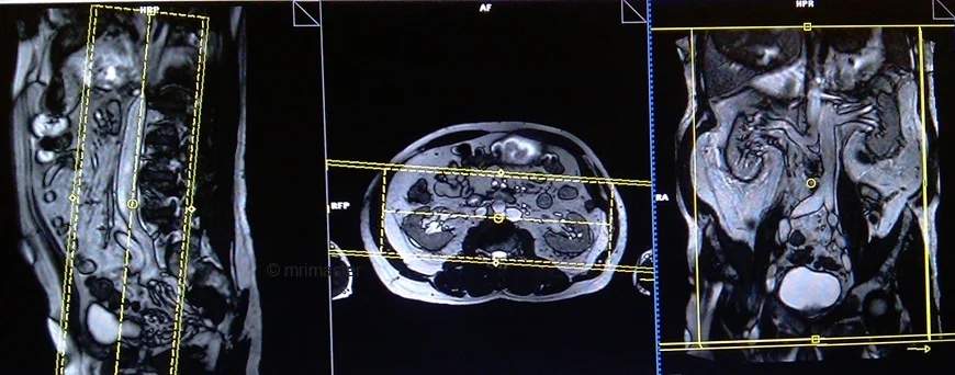 mrv abdomen coronal 3d image planning - MRI