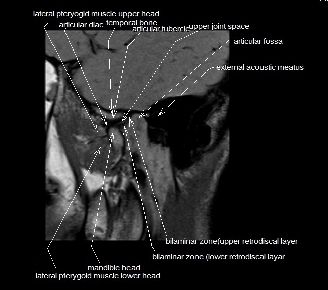 Temporomandibular Joint Anatomy | MRI TMJs Anatomy | Free Sagittal ...