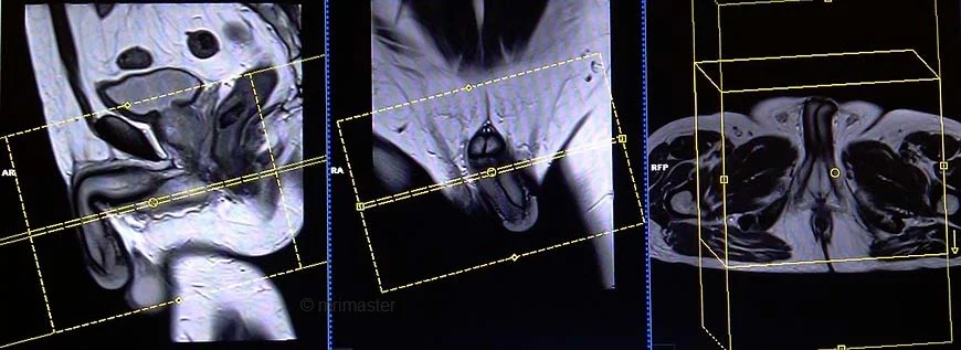 penile mri axial planning - MRI
