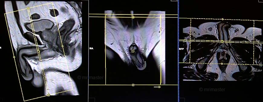 penile mri coronal planning x - MRI