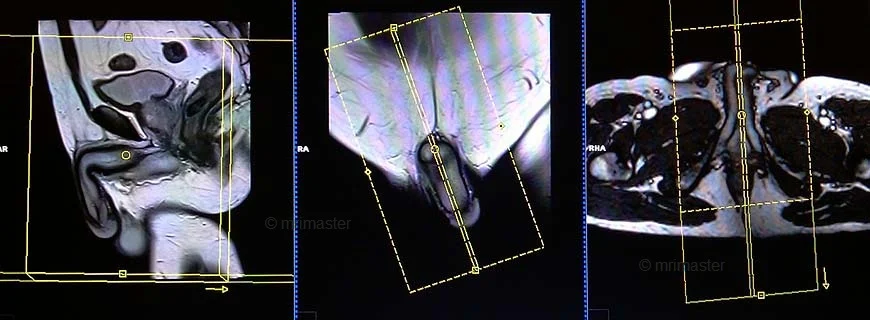 penile mri sagittal planning - MRI