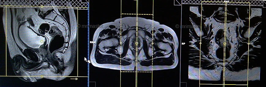 planning of mri recatal cancer sagittal - MRI