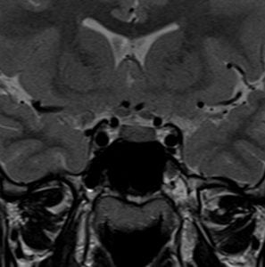 MRI pituitary mri coronal T2 images