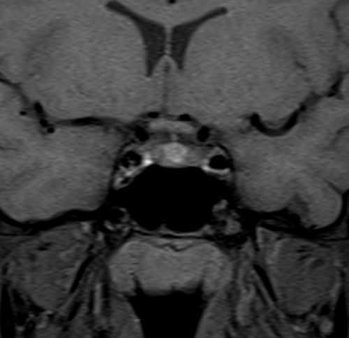 MRI pituitary coronal T1 FS non contrast images