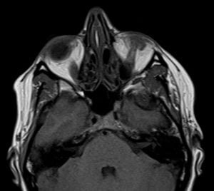 MRI trigeminal nerve axial T1 images
