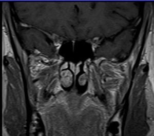 MRI trigeminal t1 coronal post contrast