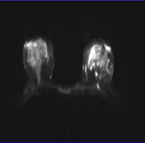 DWI BREAST IMAGE 1 - MRI
