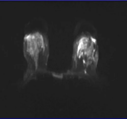 DWI BREAST IMAGE 2 - MRI