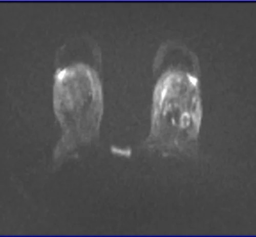 DWI BREAST IMAGE 3 - MRI
