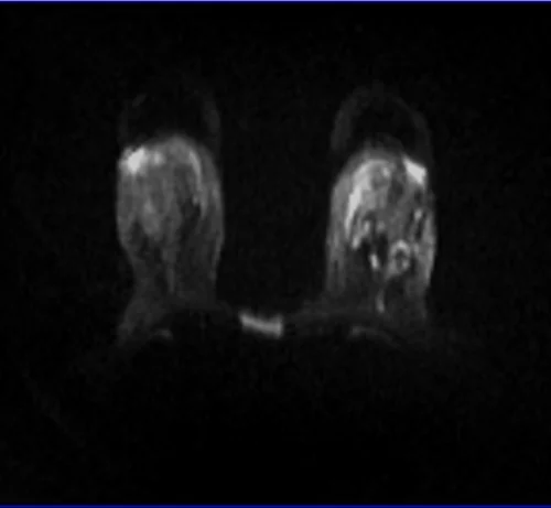 DWI BREAST IMAGE 4 - MRI