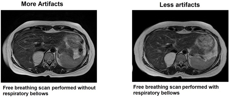Less MRI artifacts with Respiratory gating equipment’s