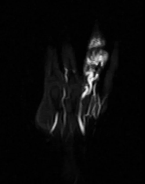 MRA hand coronal T1 post contrast arterial image 1 - MRI