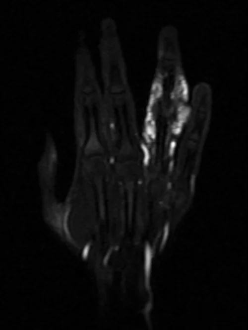 MRA hand coronal T1 post contrast arterial image 2 - MRI