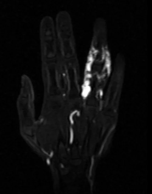 MRA hand coronal T1 post contrast arterial image 3 - MRI