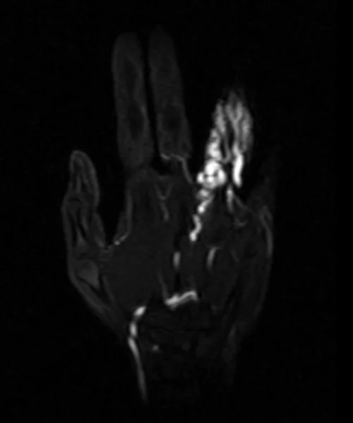 MRA hand coronal T1 post contrast arterial image 4 - MRI