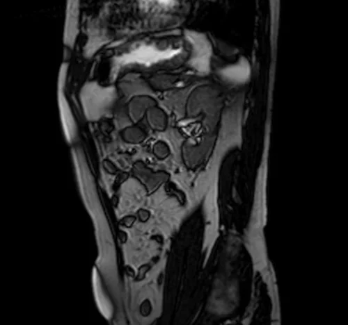 MRI ADRENAL LOCALIZER - MRI