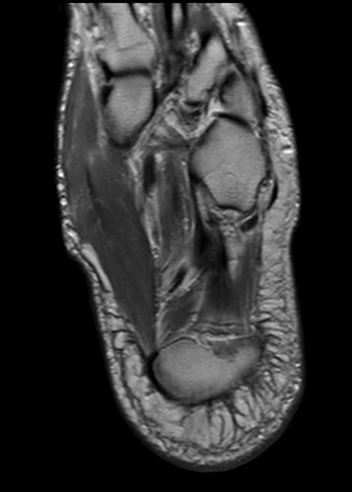 MRI ANKLE AXIAL PD IMAGE 1 - MRI