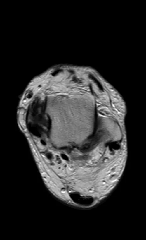 MRI ANKLE AXIAL PD IMAGE 3 - MRI