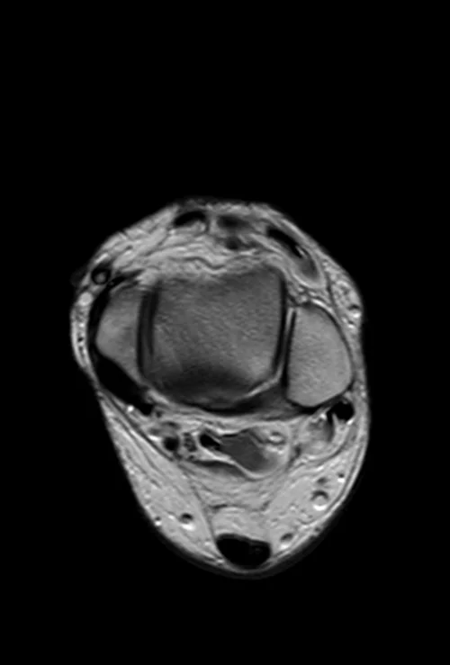 MRI ANKLE AXIAL PD IMAGE 4 - MRI