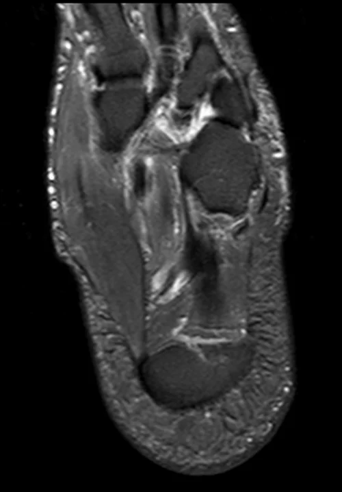 MRI ANKLE AXIAL STIR IMAGE 1 - MRI