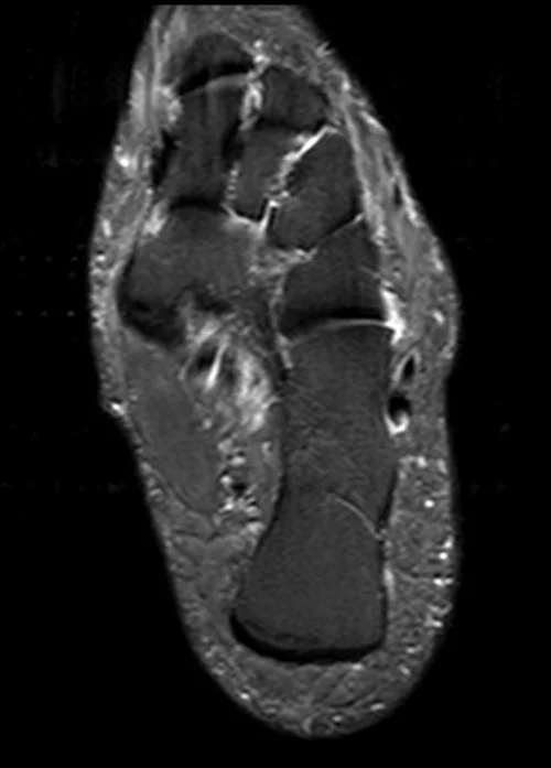 MRI ANKLE AXIAL STIR IMAGE 2 - MRI