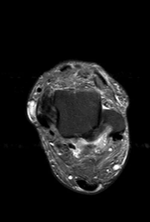 MRI ANKLE AXIAL STIR IMAGE 3 - MRI