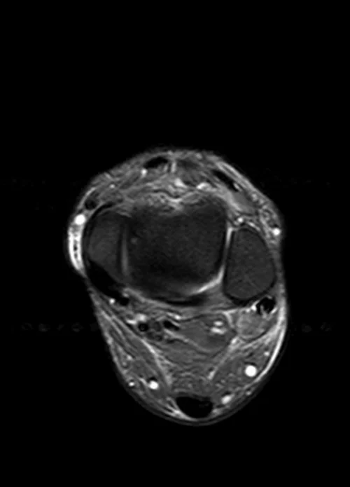 MRI ANKLE AXIAL STIR IMAGE 4 - MRI