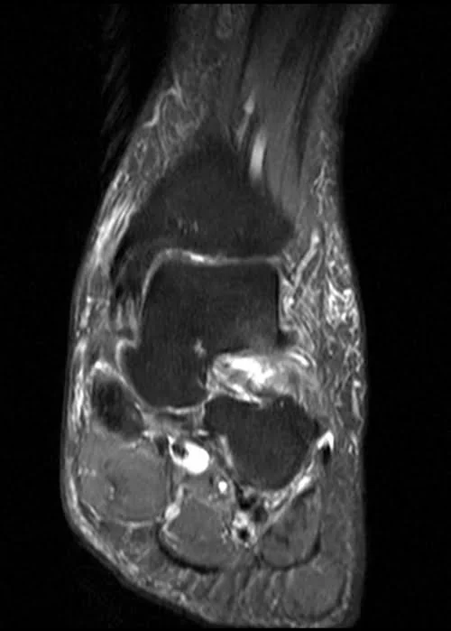 MRI ANKLE COR PD FS IMAGE 1 - MRI