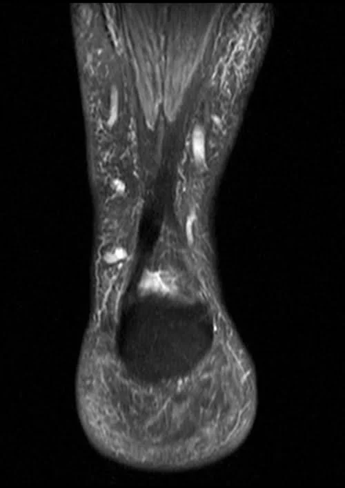 MRI ANKLE COR PD FS IMAGE 3 - MRI