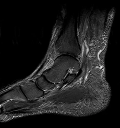 MRI ANKLE SAG STIR IMAGE 1 - MRI