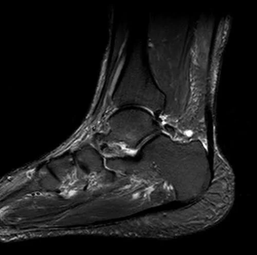 MRI ANKLE SAG STIR IMAGE 2 - MRI