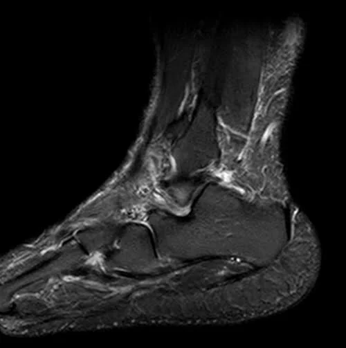 MRI ANKLE SAG STIR IMAGE 3 - MRI