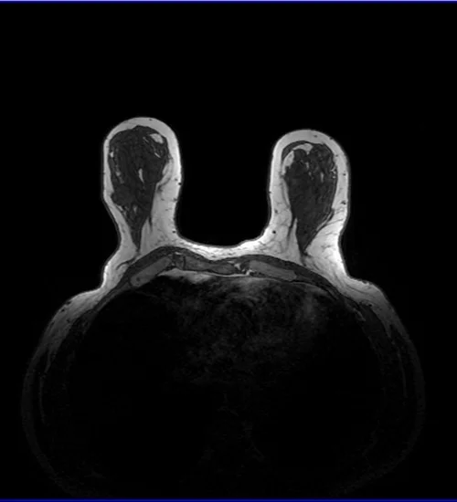 MRI AXIAL BREAST T1 IMAGE 1 - MRI