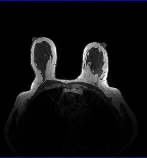 MRI AXIAL BREAST T1 IMAGE 2 - MRI