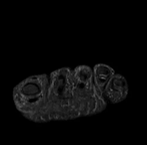 MRI FOOT AXIAL STIR IMAGE 1 - MRI