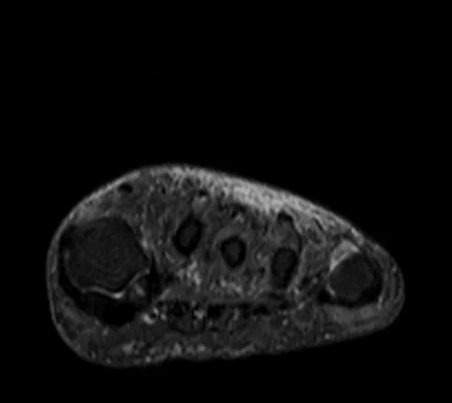 MRI FOOT AXIAL STIR IMAGE 2 - MRI