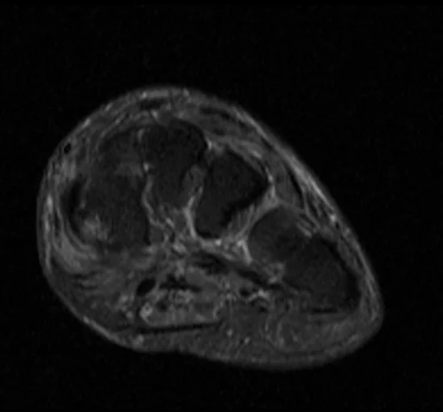 MRI FOOT AXIAL STIR IMAGE 3 - MRI