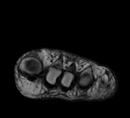 MRI FOOT AXIAL T1 IMAGE 1 - MRI