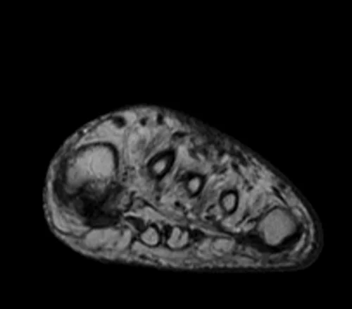 MRI FOOT AXIAL T1 IMAGE 2 - MRI